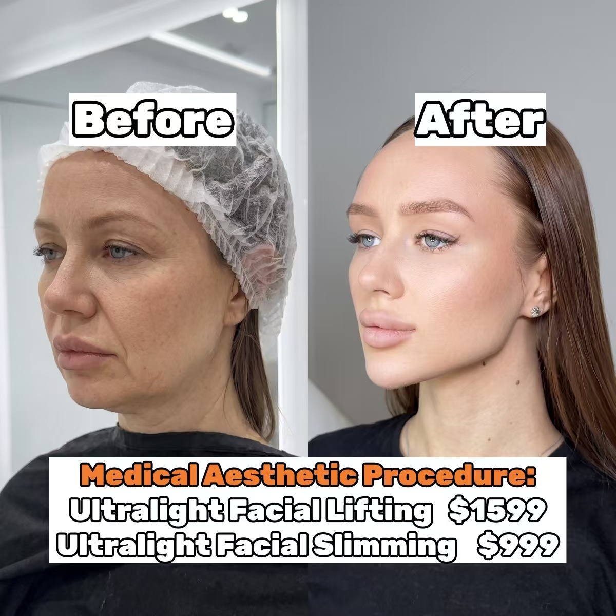Ultra light facelift before and after case
