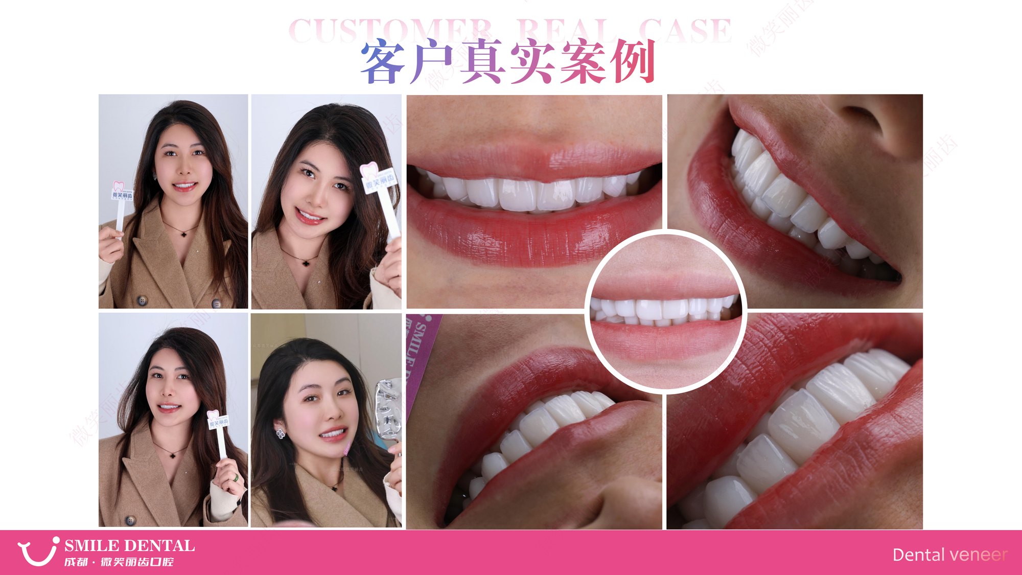 Smile Dental Aesthetic Clinic translated English material and case image 014