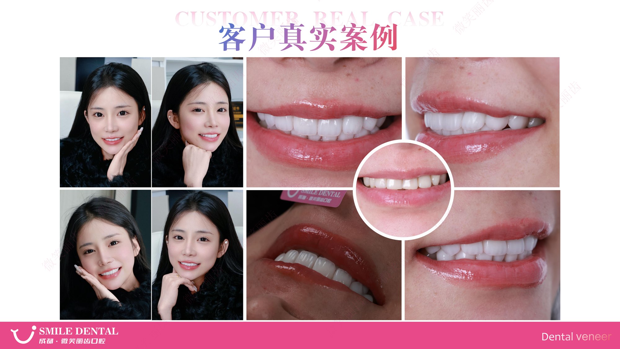 Smile Dental Aesthetic Clinic translated English material and case image 015