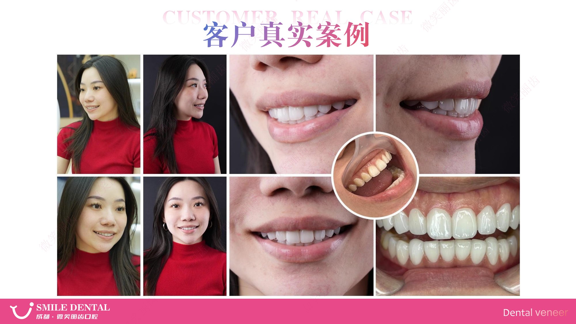 Smile Dental Aesthetic Clinic translated English material and case image 022