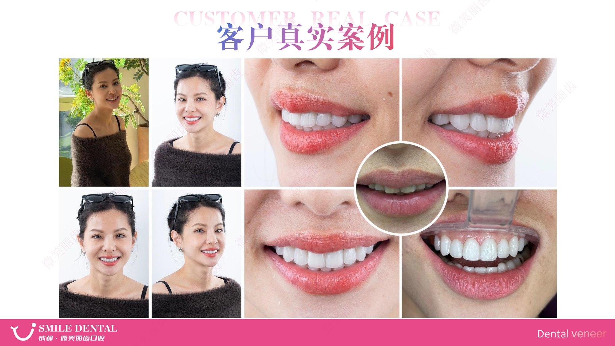Smile Dental Aesthetic Clinic translated English material and case image 023