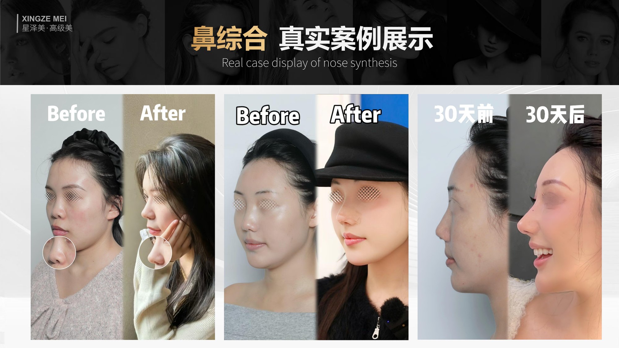Xingze Medical Aesthetics translated English material and case image 017