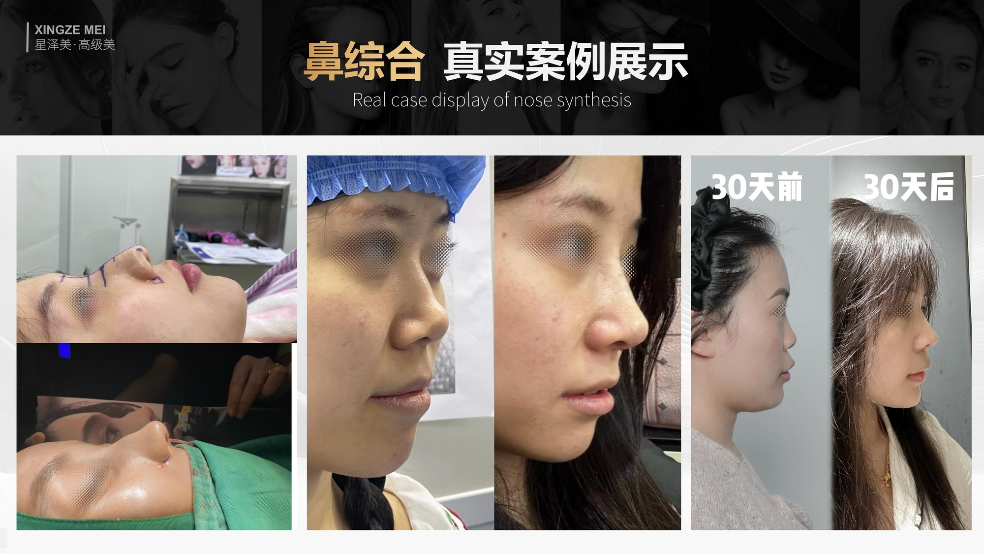 Xingze Medical Aesthetics translated English material and case image 018