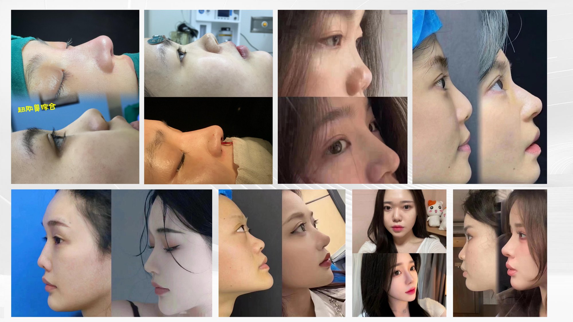 Xingze Medical Aesthetics translated English material and case image 020