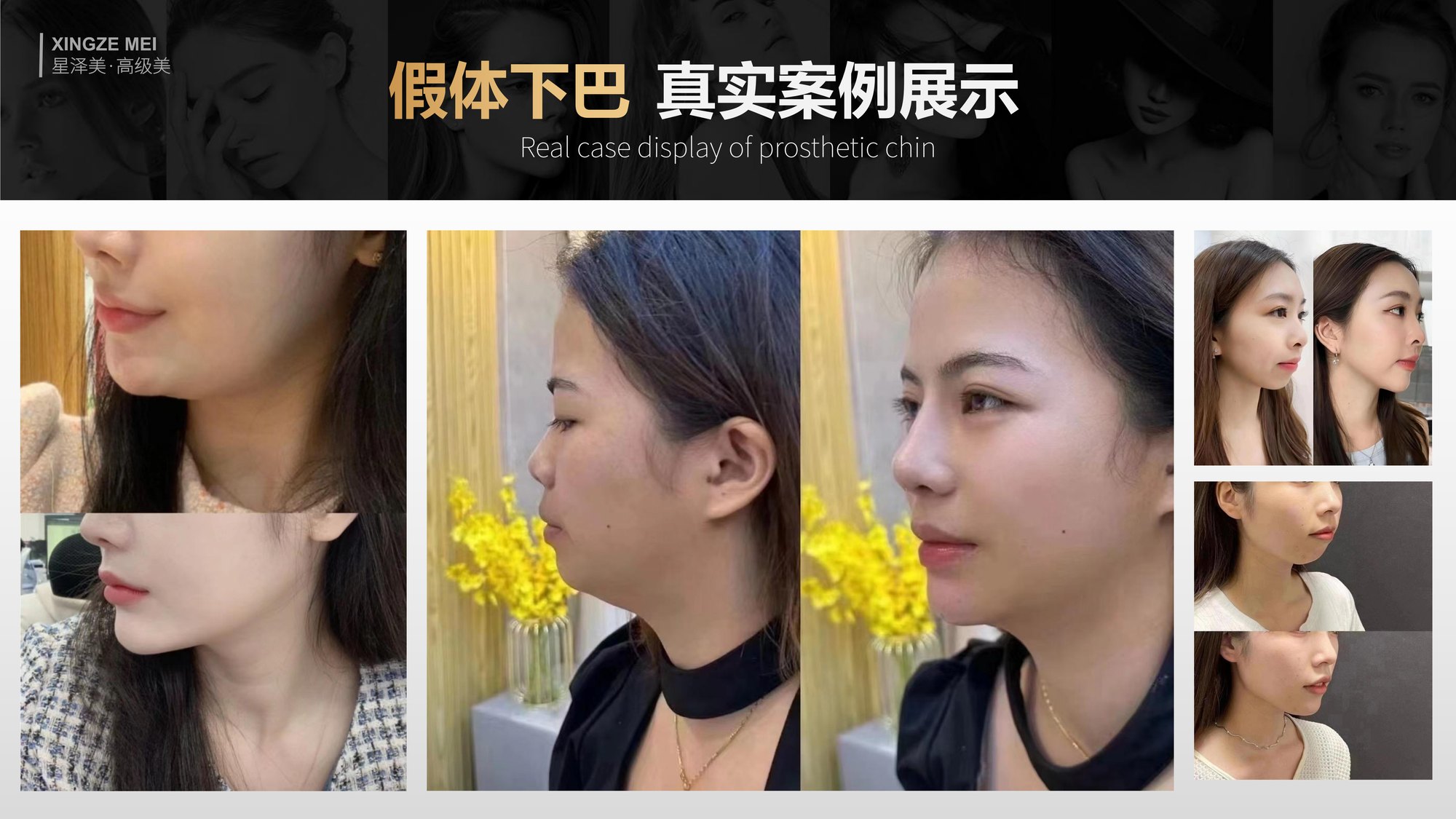 Xingze Medical Aesthetics translated English material and case image 023