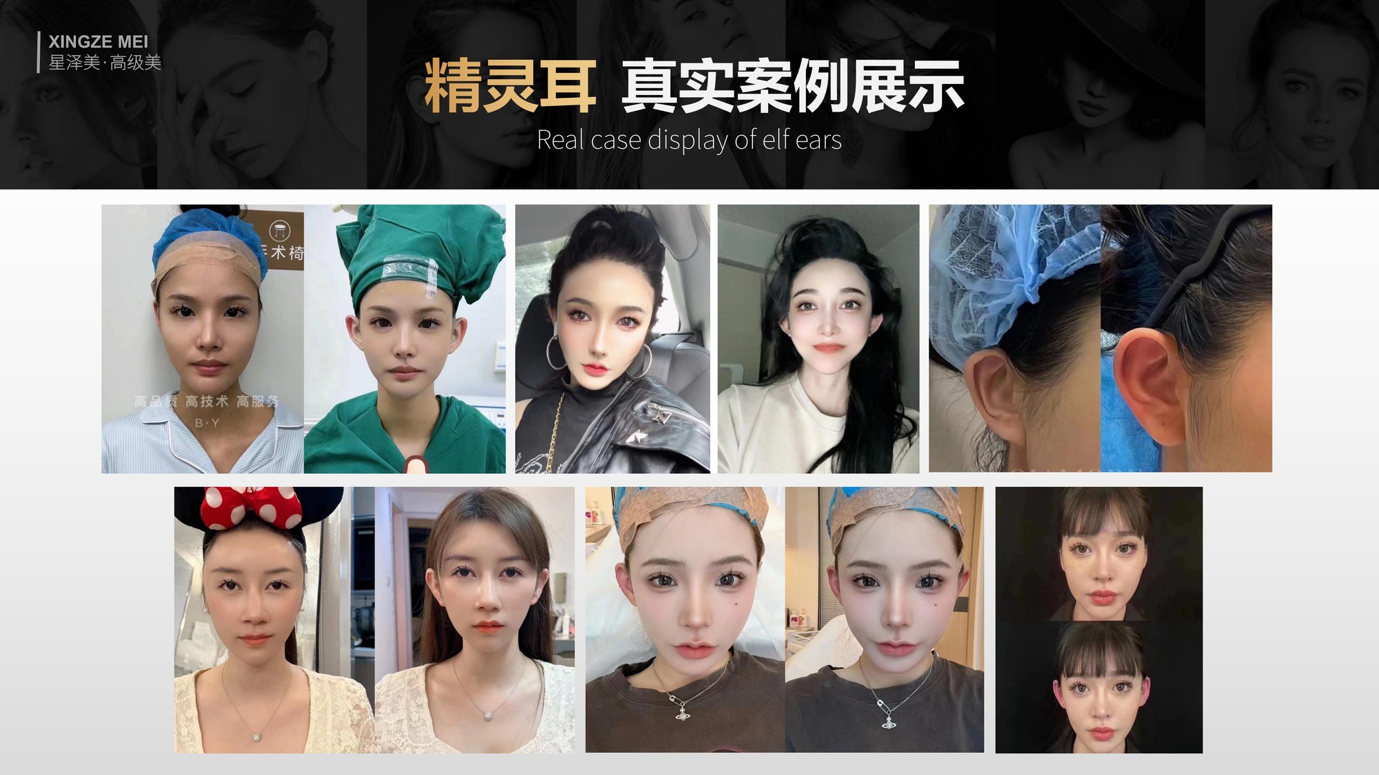 Xingze Medical Aesthetics translated English material and case image 025