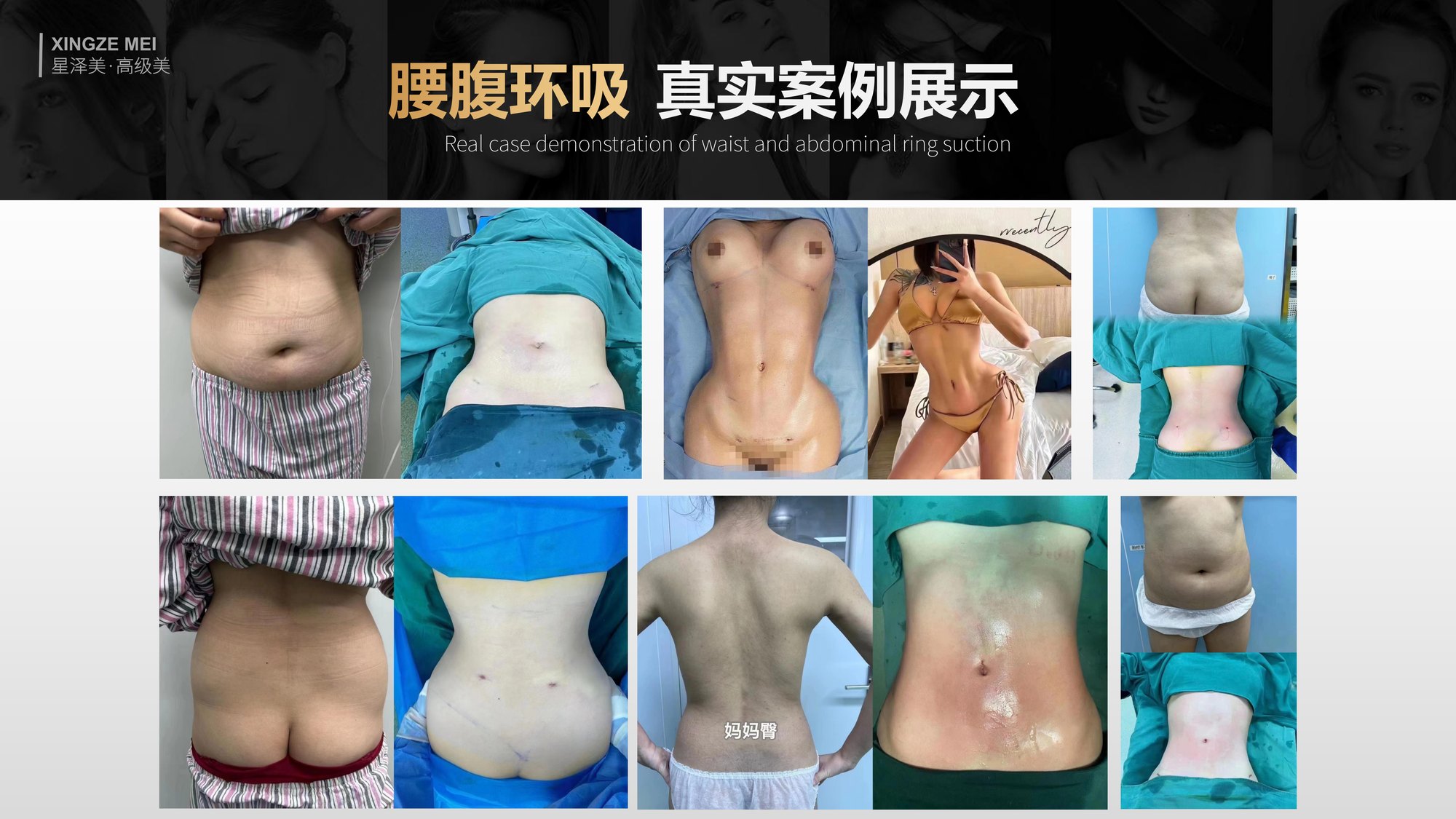 Xingze Medical Aesthetics translated English material and case image 026