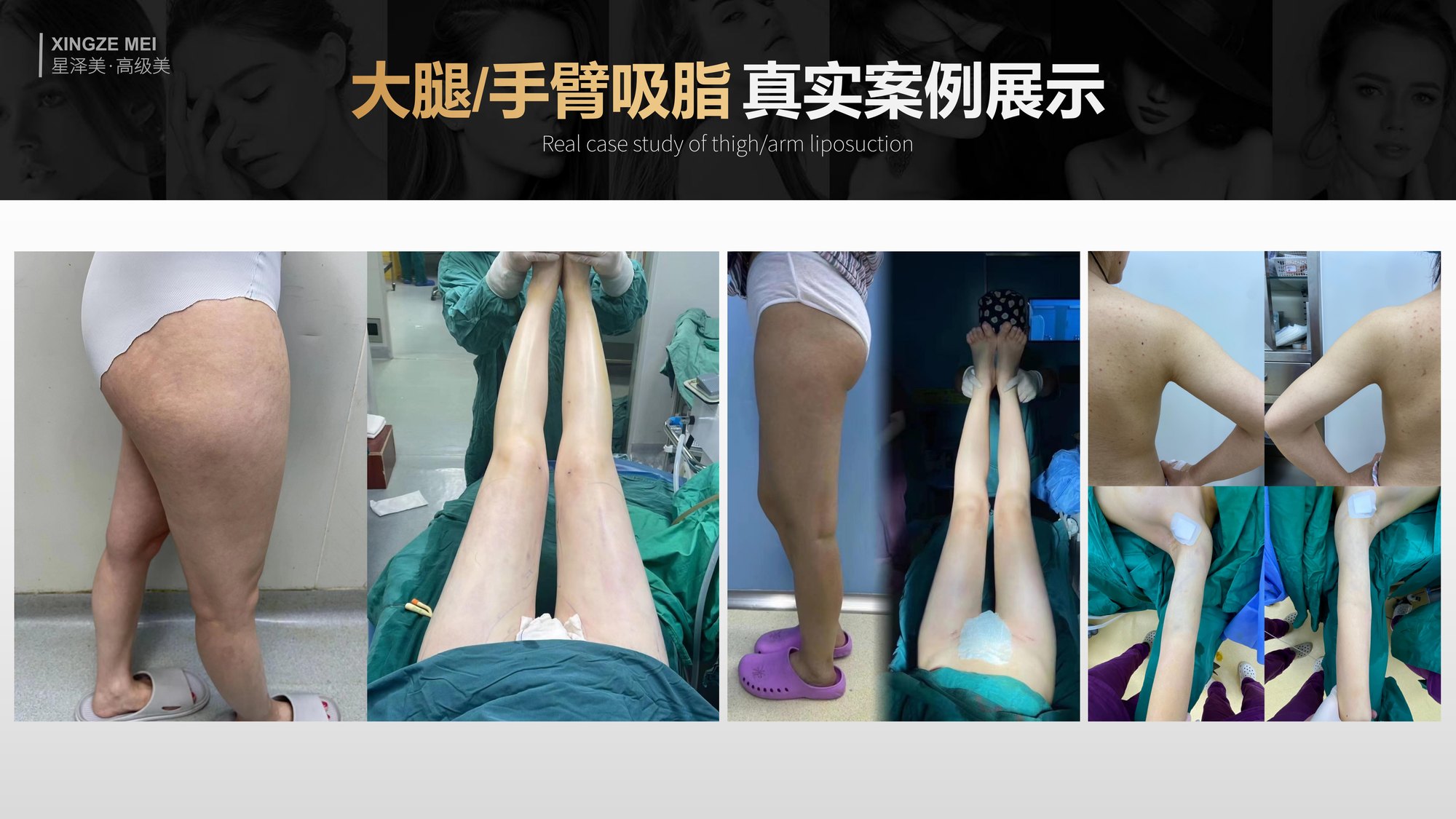 Xingze Medical Aesthetics translated English material and case image 027