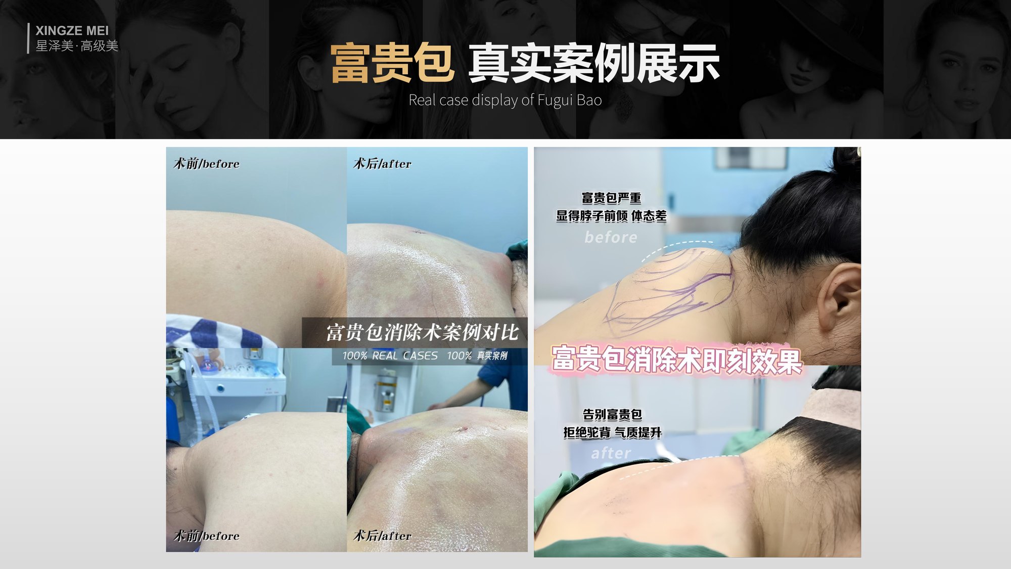 Xingze Medical Aesthetics translated English material and case image 028