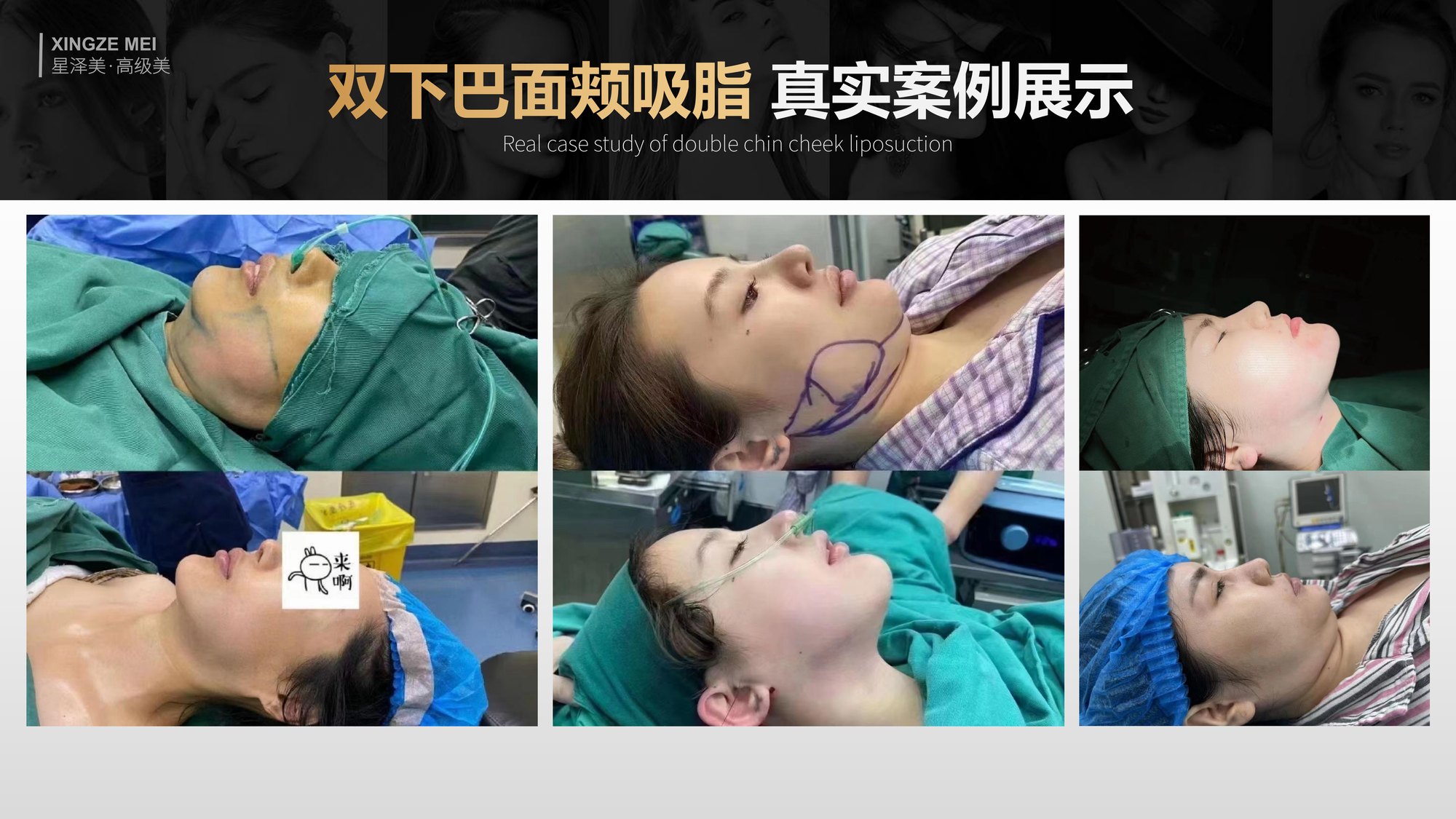 Xingze Medical Aesthetics translated English material and case image 029