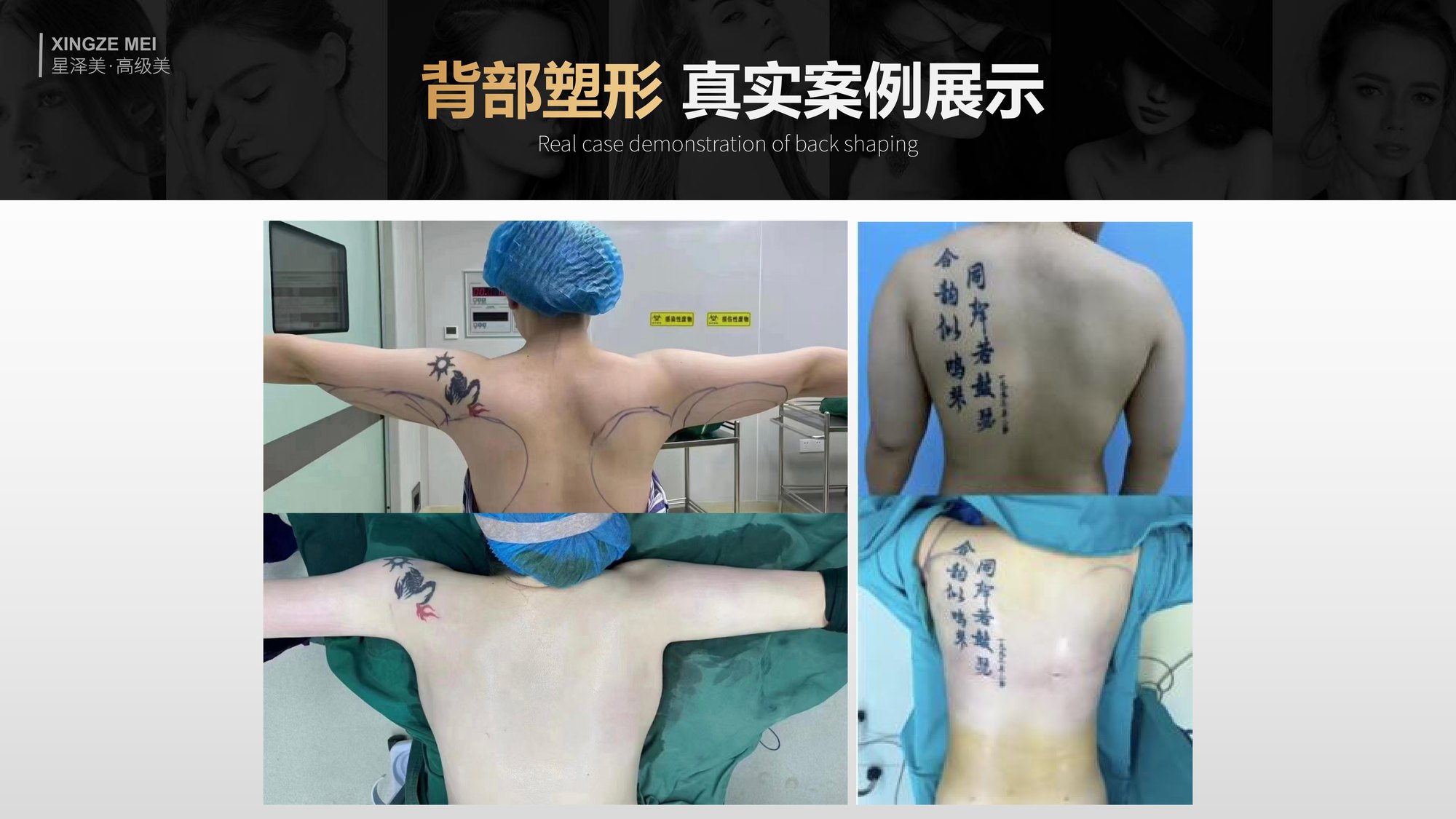 Xingze Medical Aesthetics translated English material and case image 030
