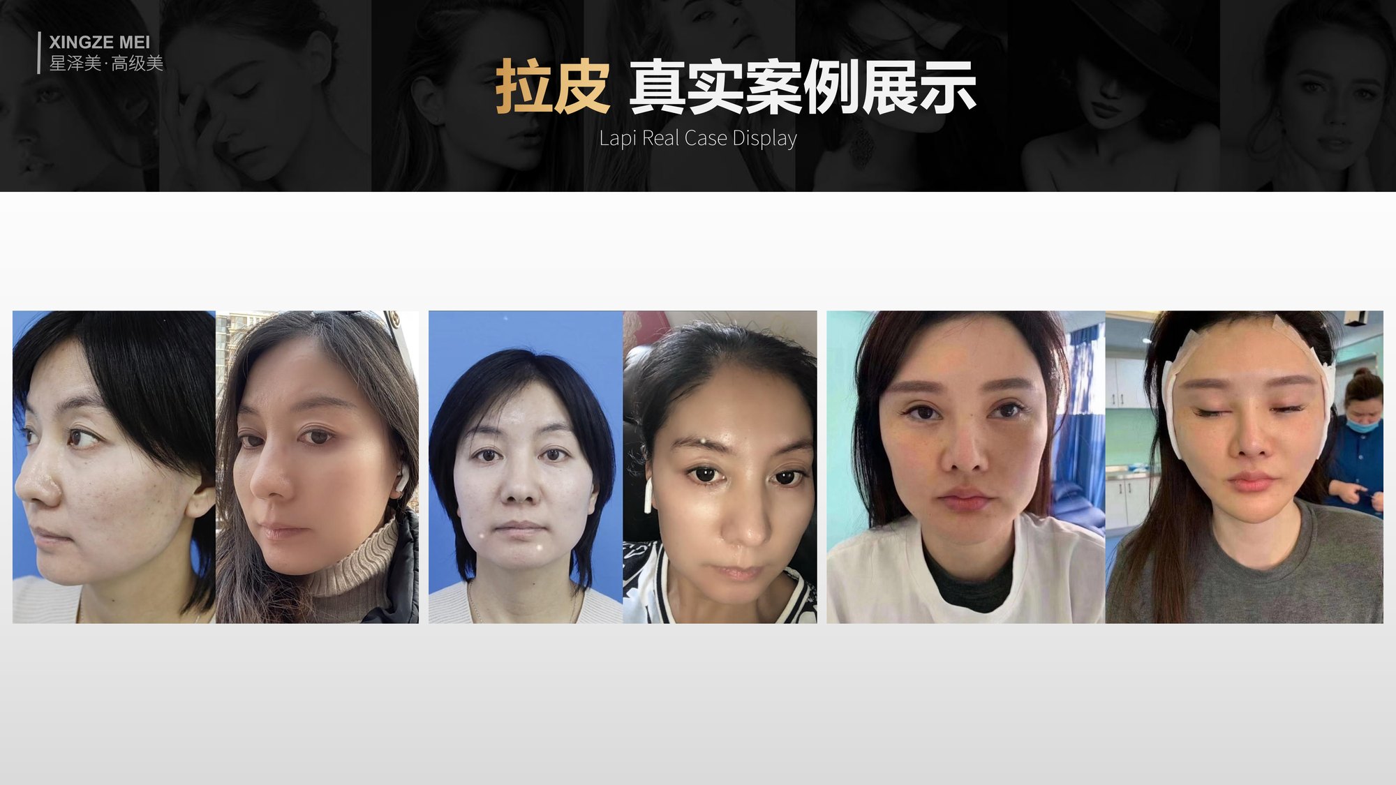 Xingze Medical Aesthetics translated English material and case image 031