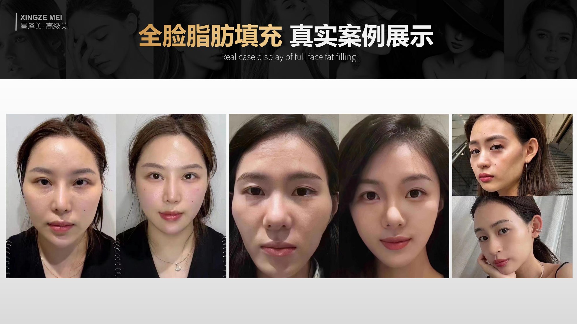 Xingze Medical Aesthetics translated English material and case image 032