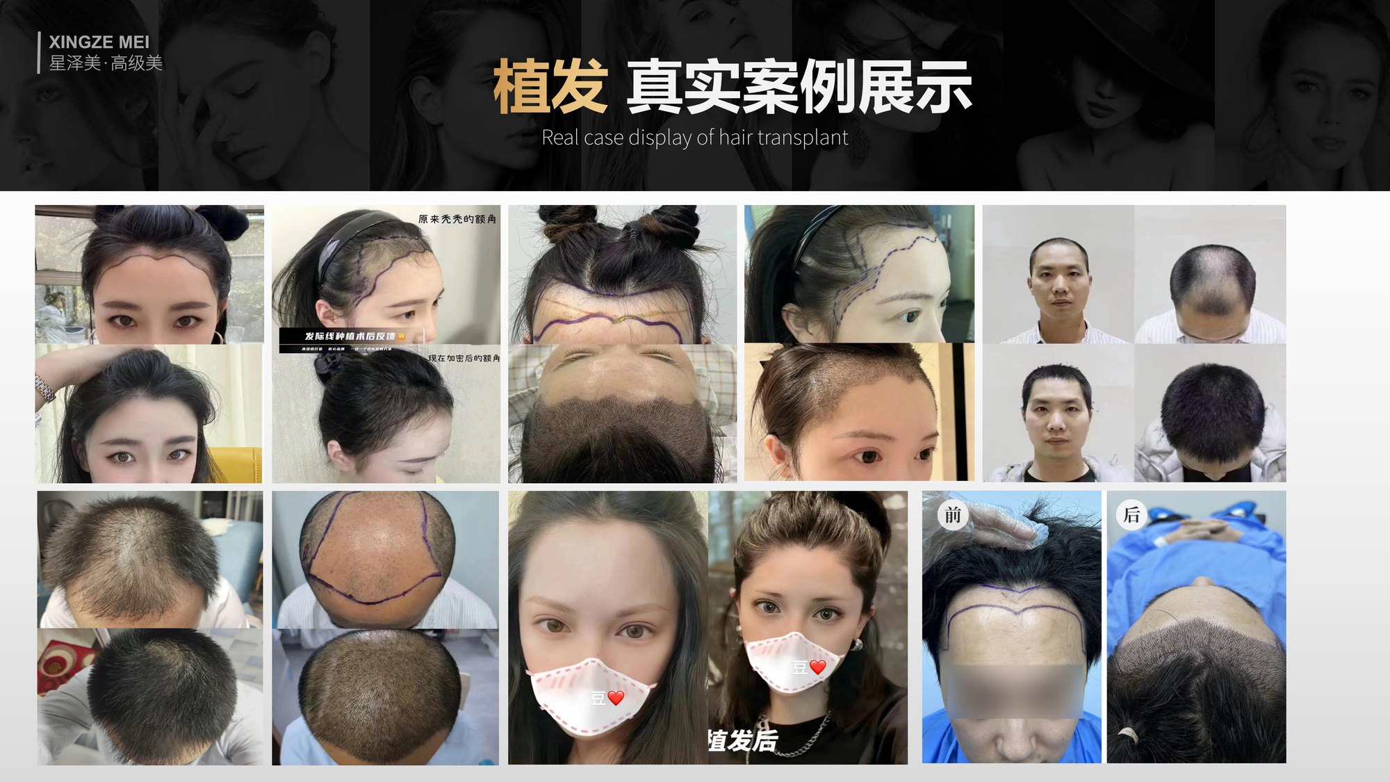 Xingze Medical Aesthetics translated English material and case image 033