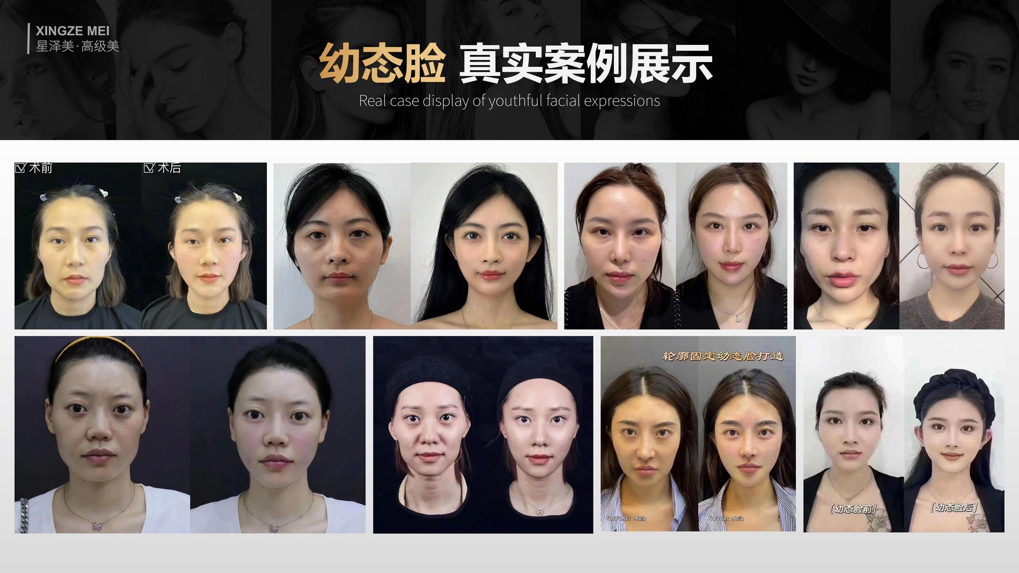 Xingze Medical Aesthetics translated English material and case image 034