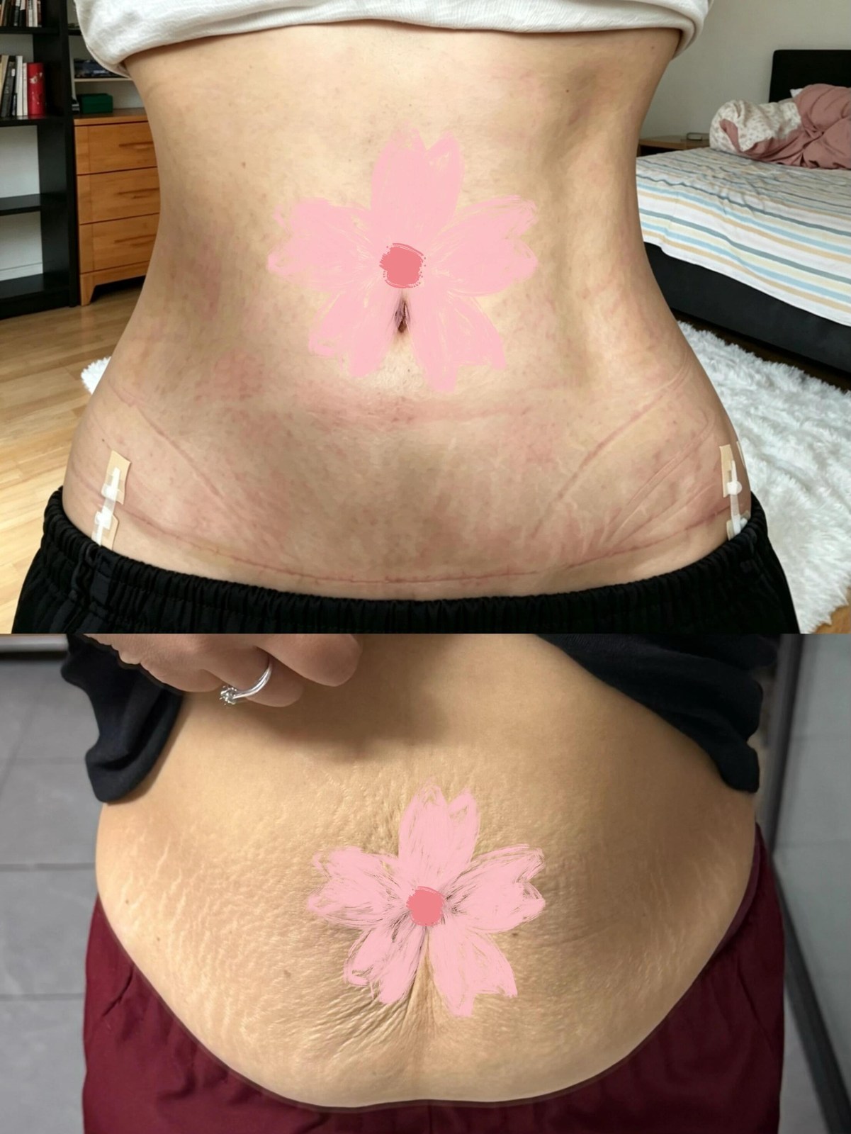 Abdominoplasty Case 01 before and after