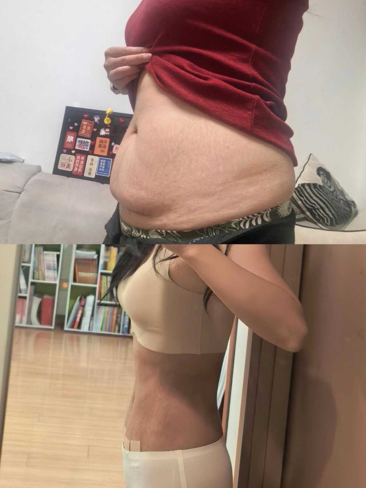 Abdominoplasty Case 03 before and after