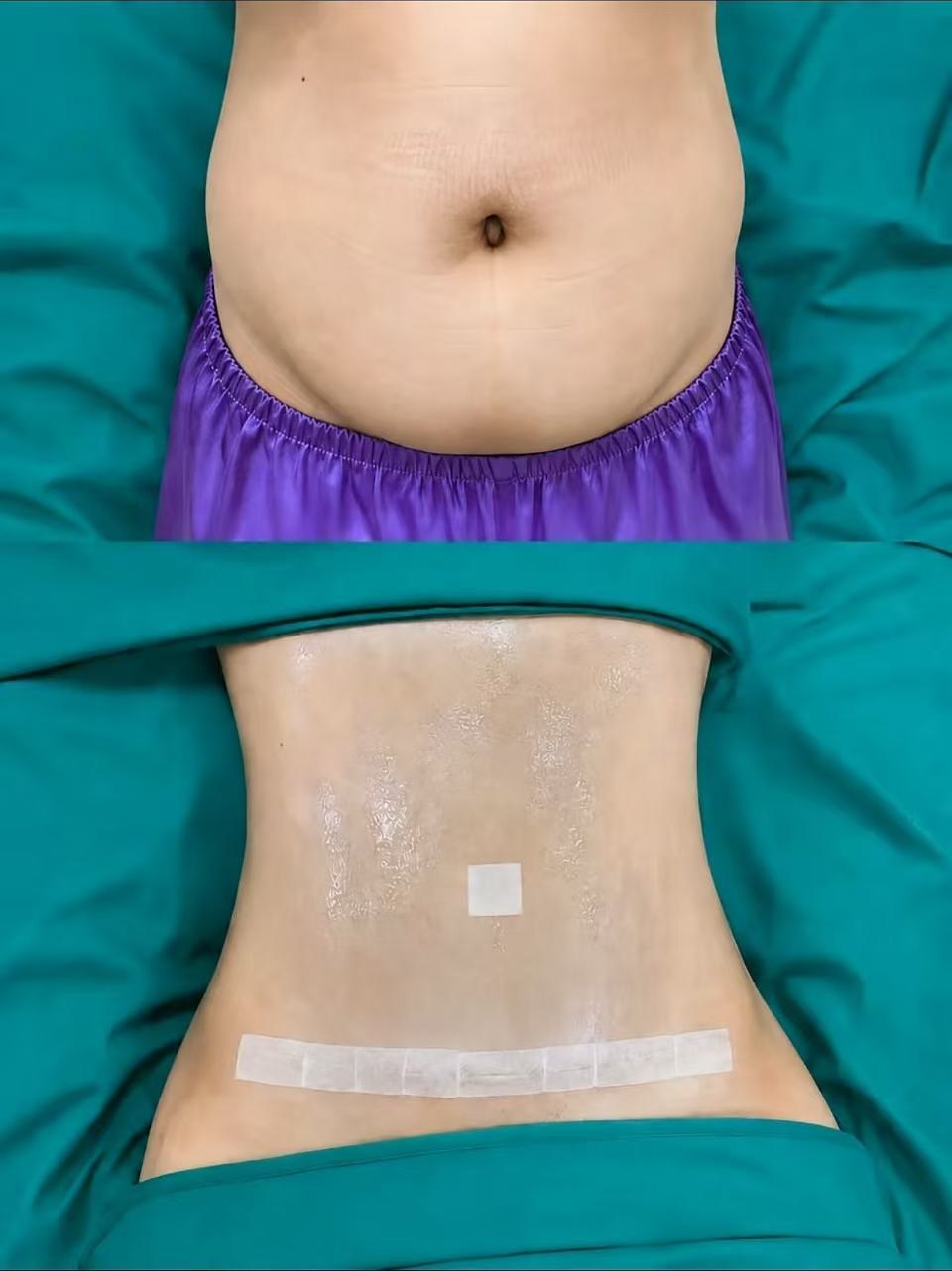 Abdominoplasty Case 04 before and after