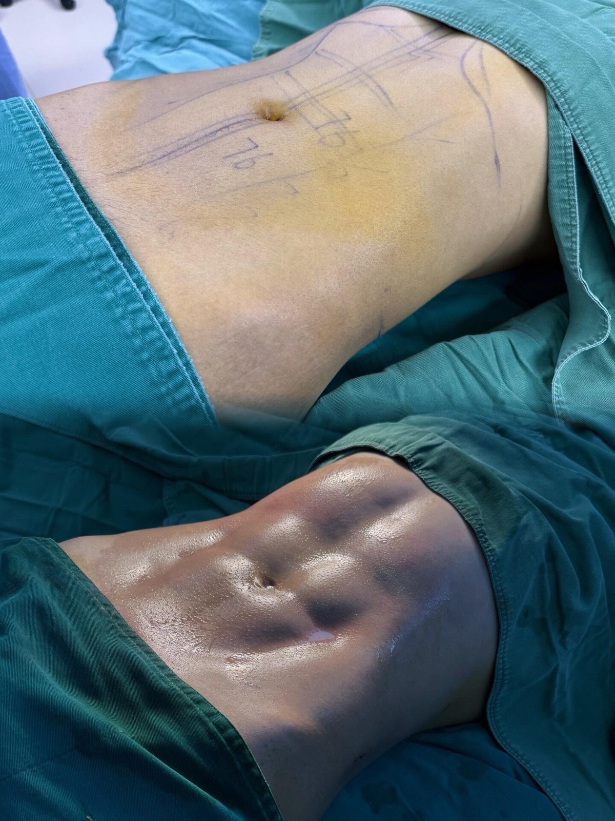 Body Liposuction Case 01 before and after