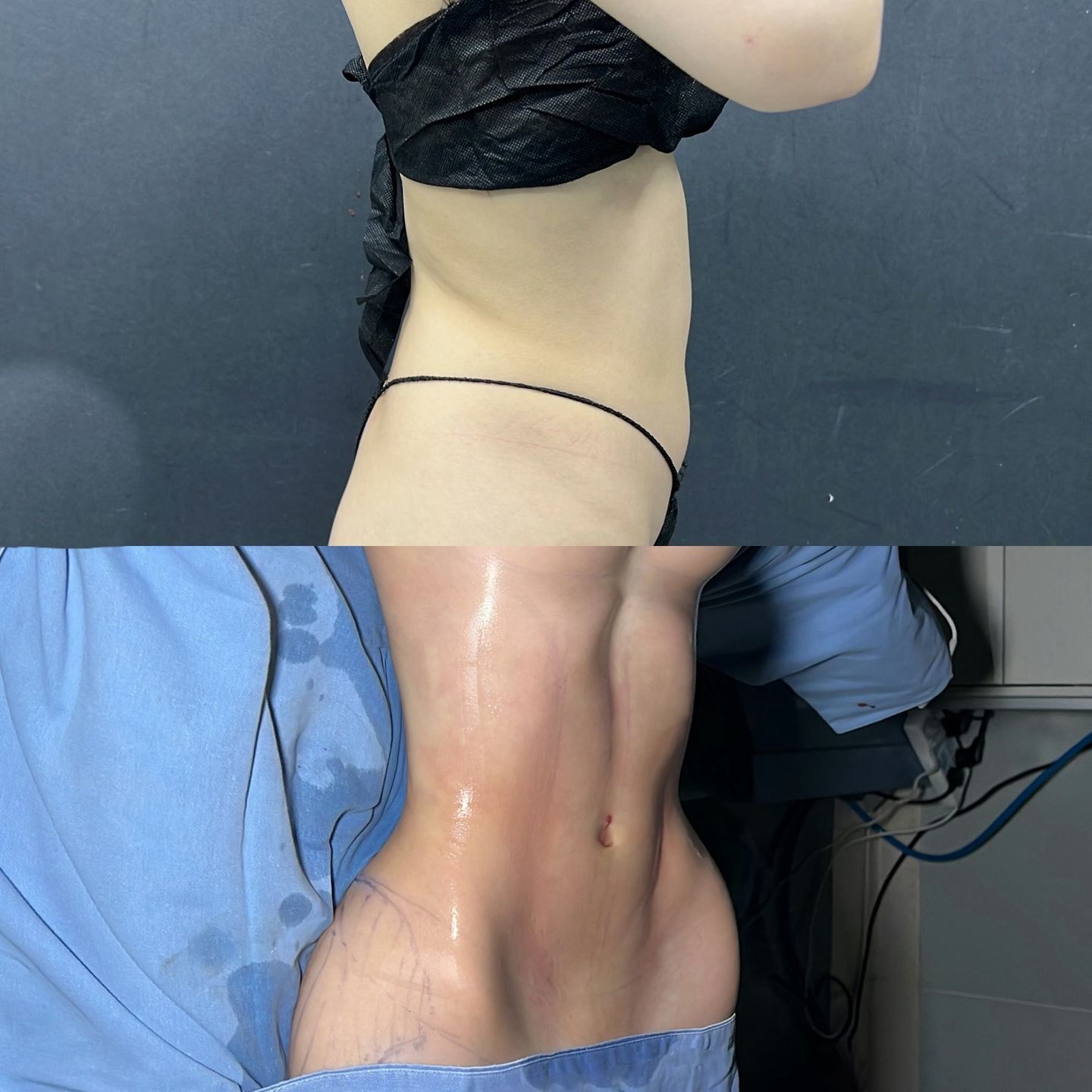 Body Liposuction Case 02 before and after
