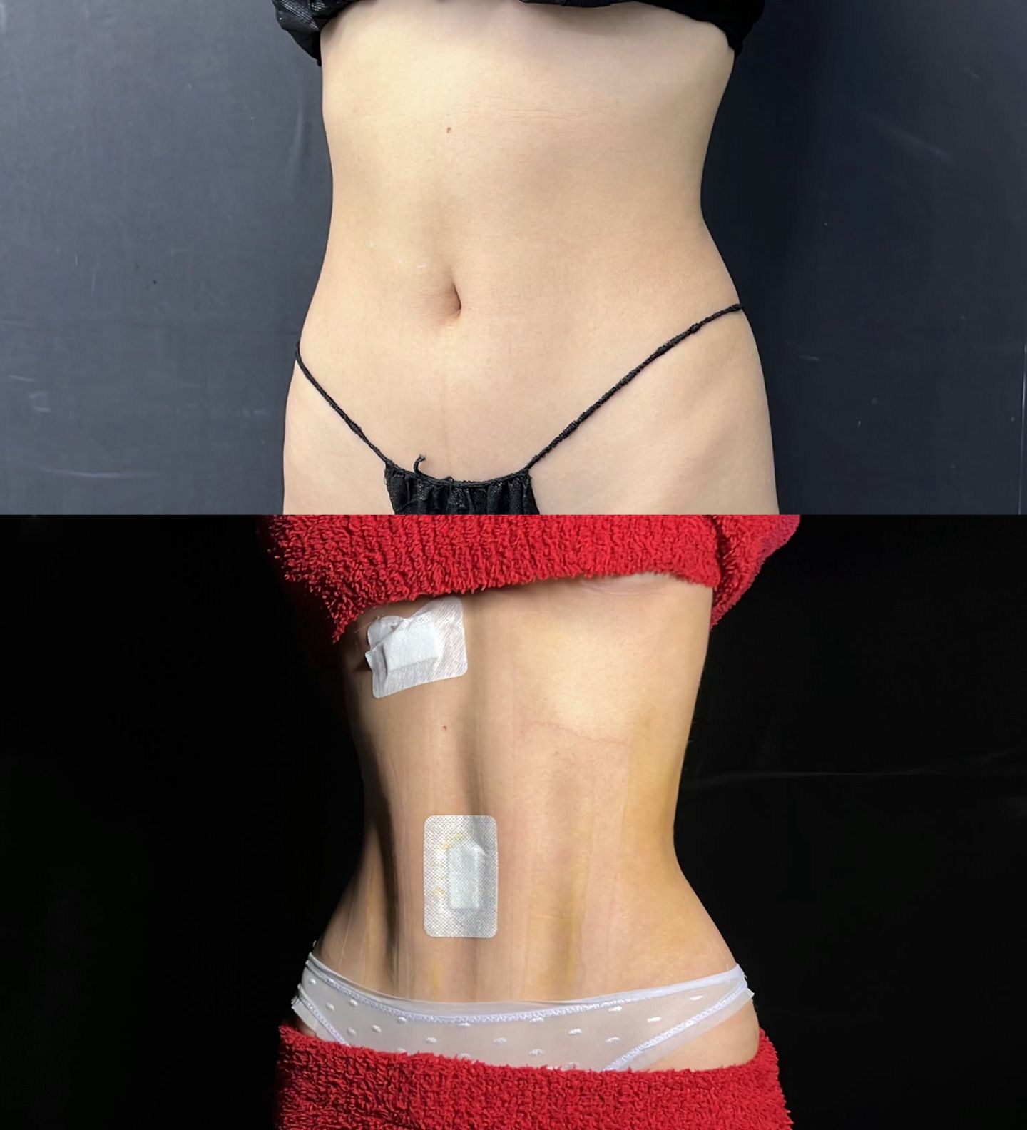 Body Liposuction Case 03 before and after