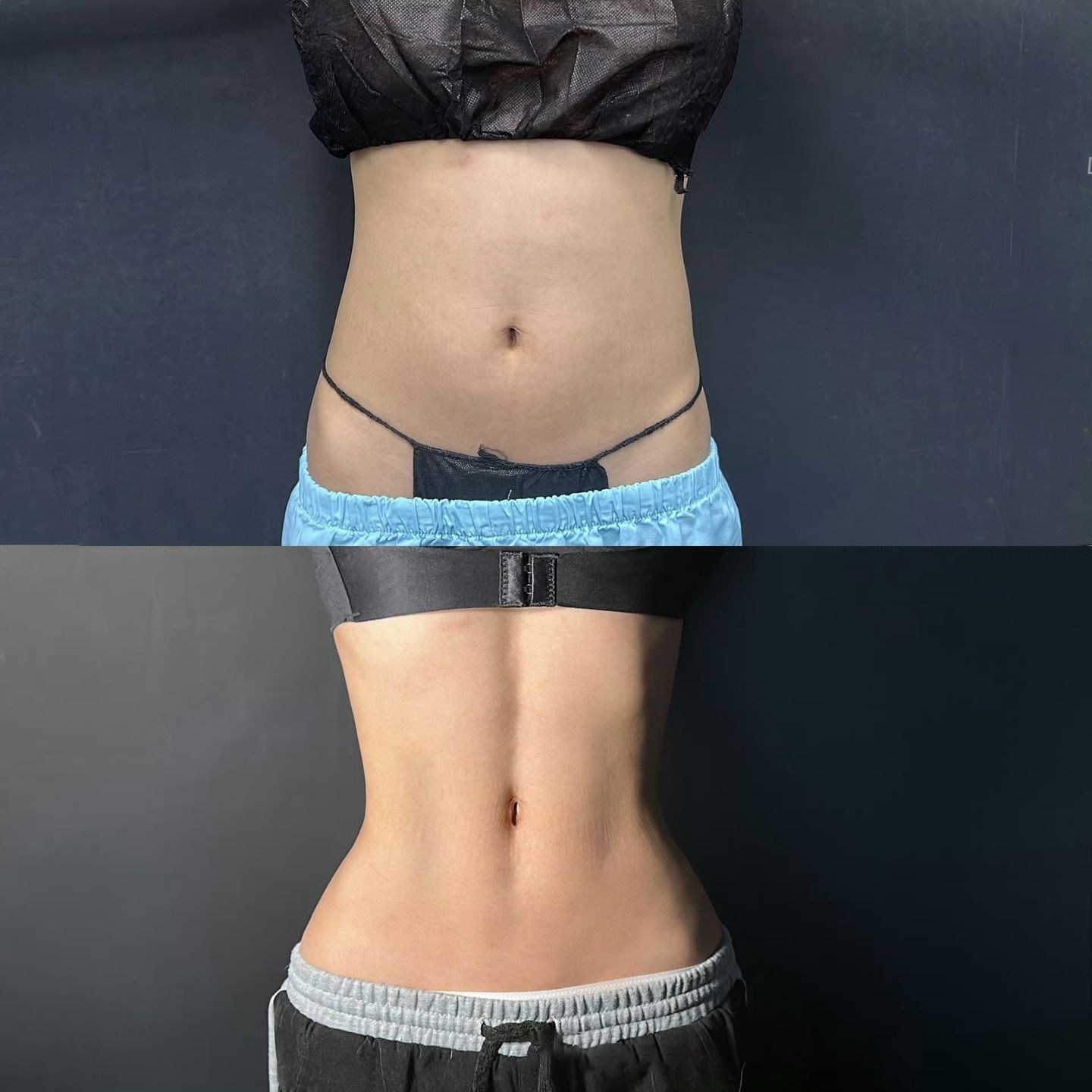 Body Liposuction Case 04 before and after