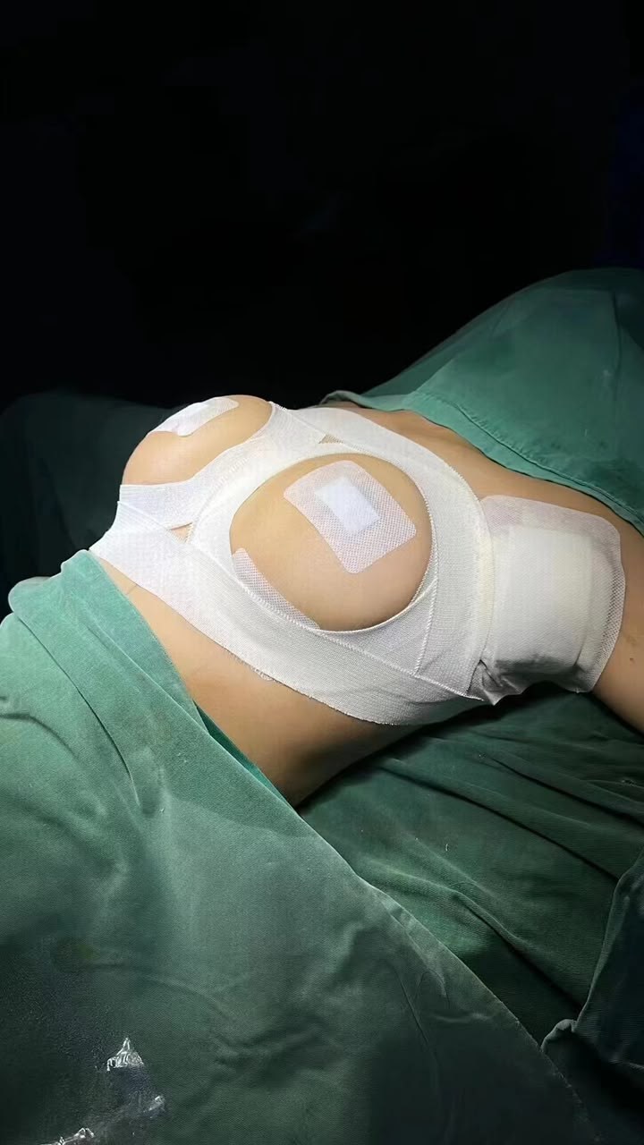 Breast Augmentation Case 02 before and after