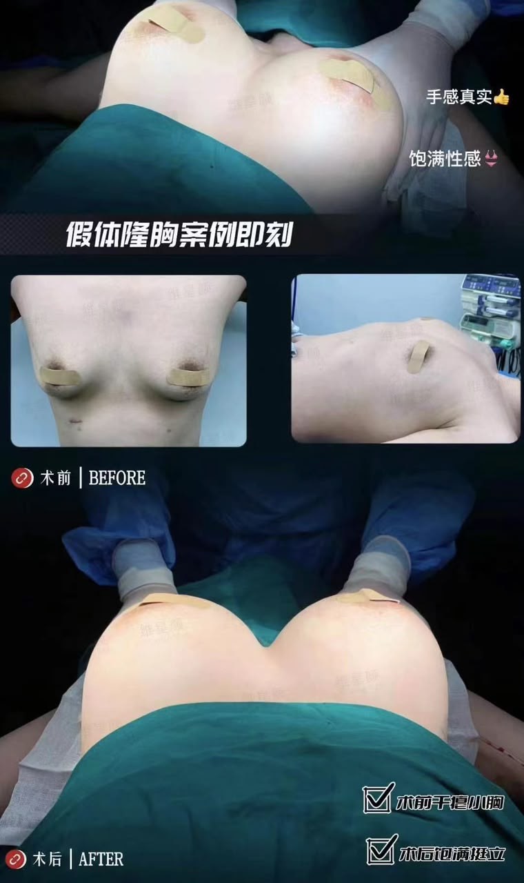 Breast Augmentation Case 04 before and after