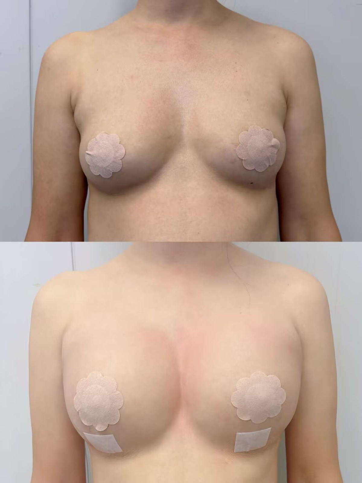 Breast Augmentation Case 06 before and after