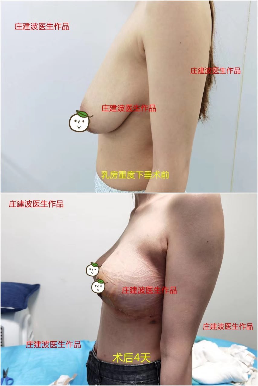 Breast Lift Case 01 before and after