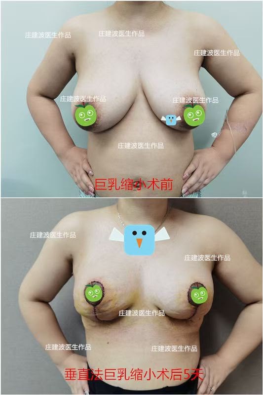 Breast Lift Case 03 before and after