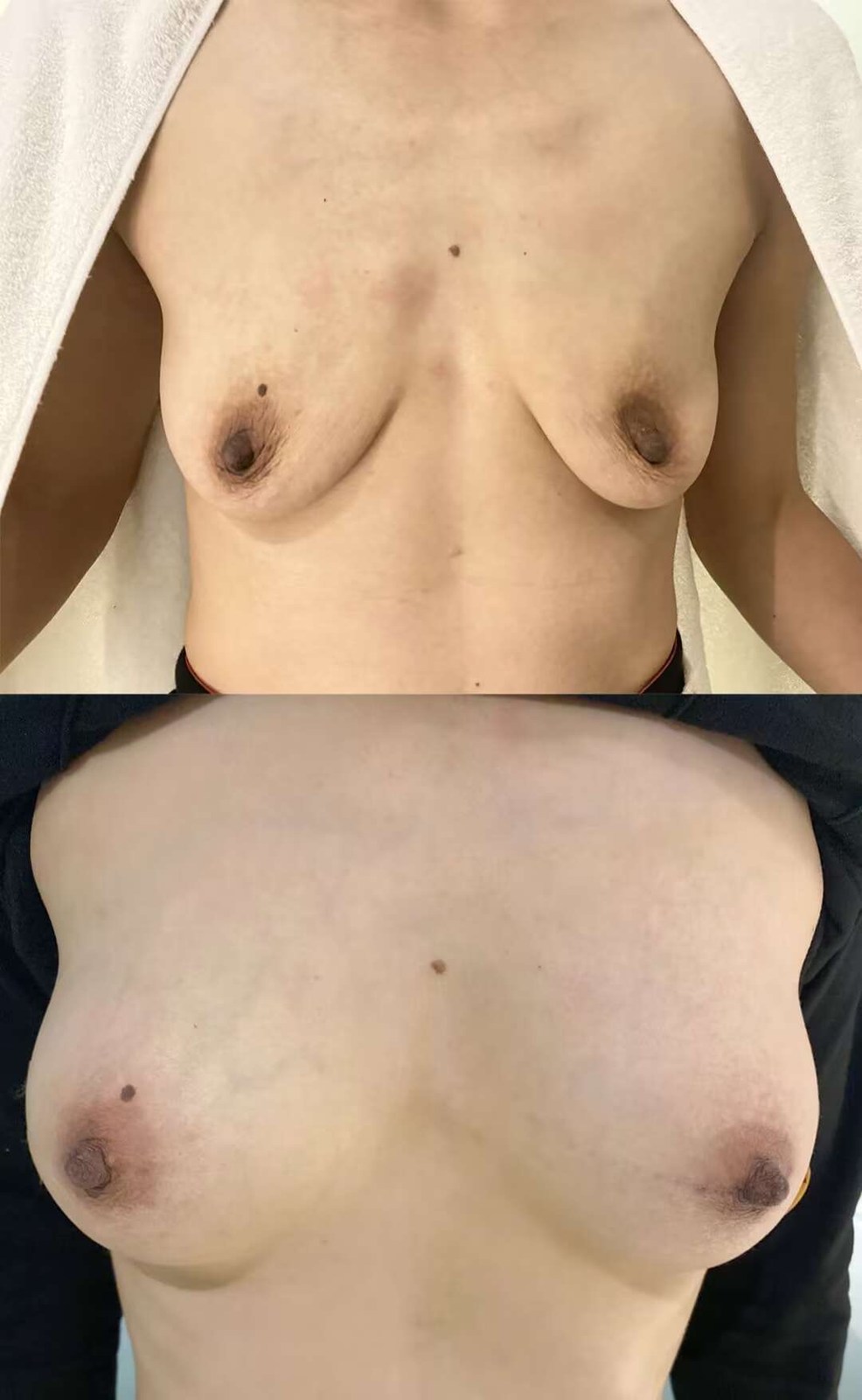 Breast Lift Case 05 before and after
