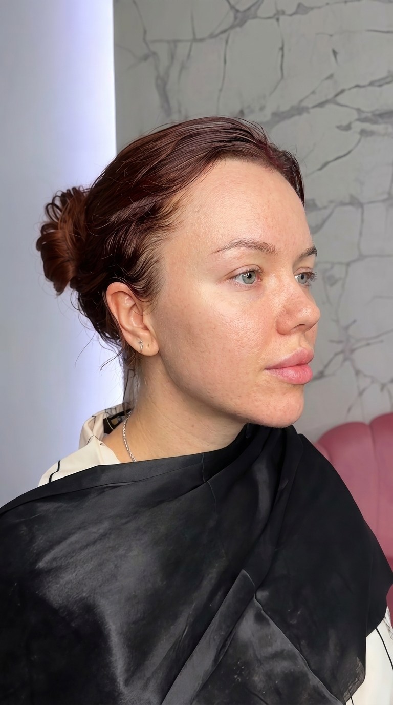 Face Liposuction Case 01 before and after