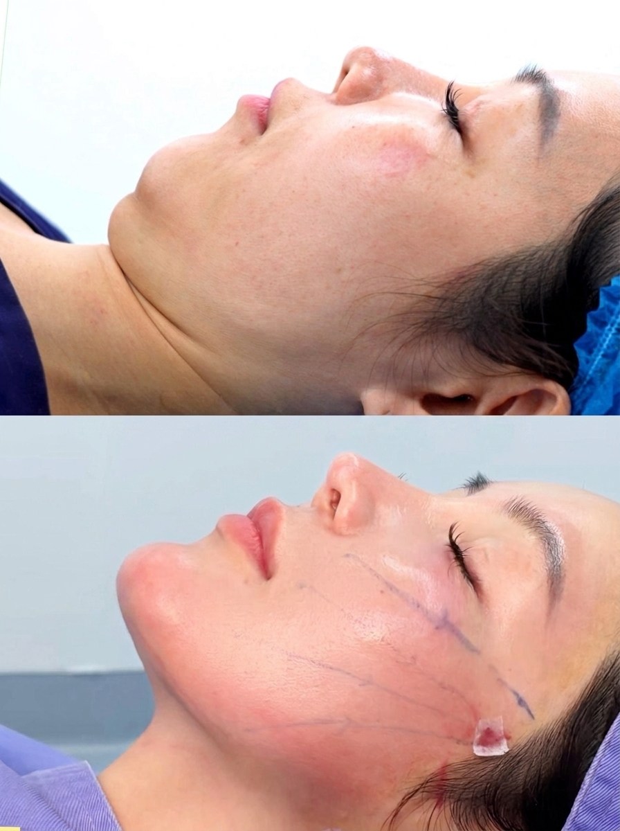 Face Liposuction Case 03 before and after