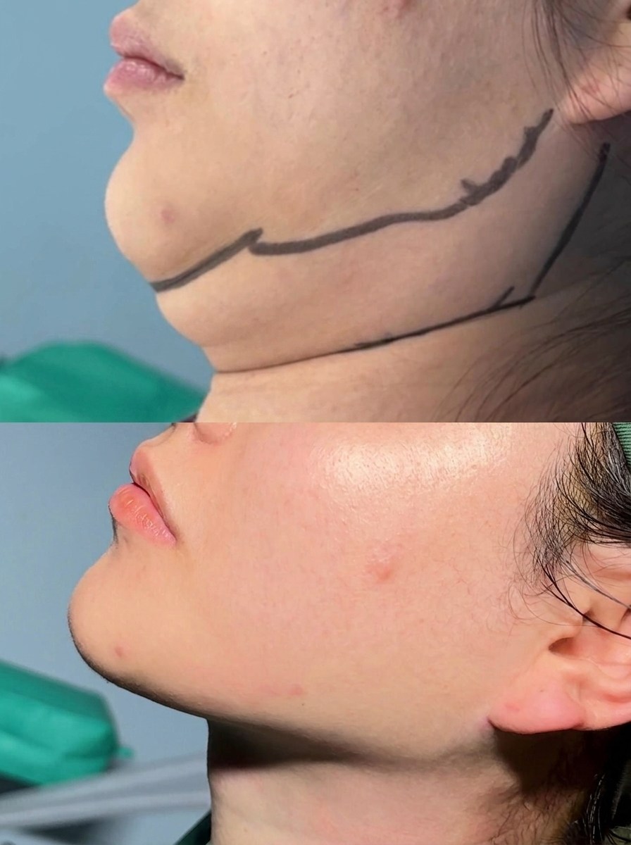 Face Liposuction Case 04 before and after
