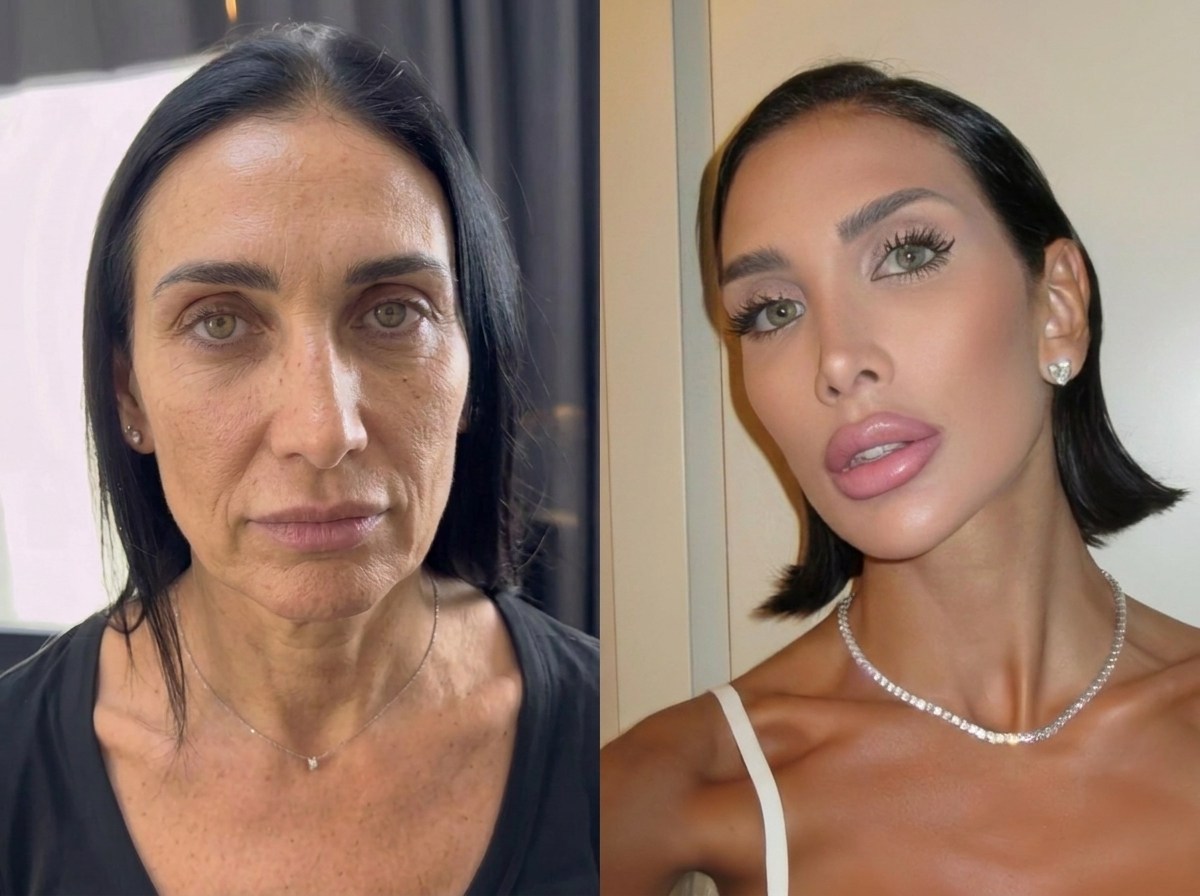 Ultralight Facelift Case 05 before and after